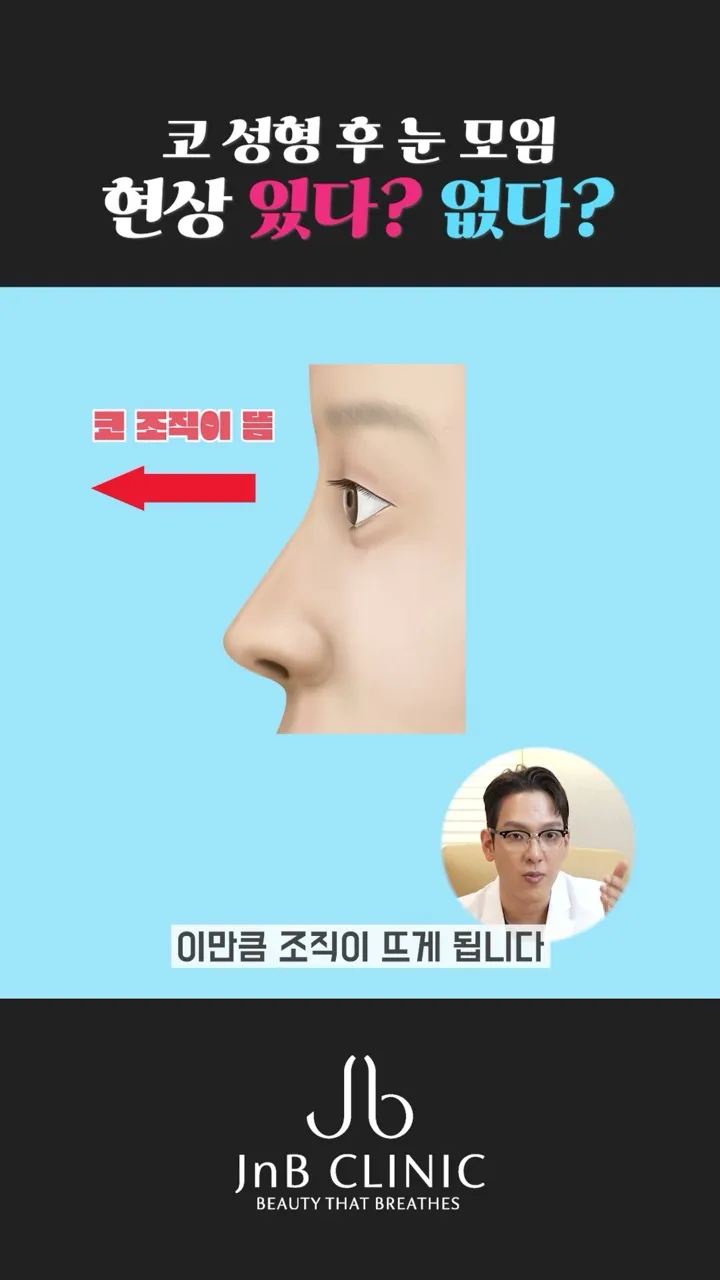 콧대 시작점까지 높이면 그만큼 코 조직이 앞으로 뜬다는 설명 도해 — 유튜브 JNB Behind 0분 12초 화면