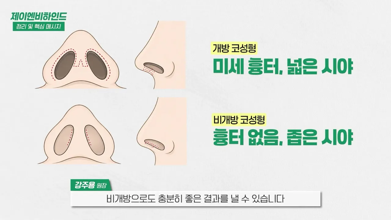 개방 코성형은 미세 흉터에 넓은 시야, 비개방 코성형은 흉터 없이 좁은 시야 — 유튜브 JNB Behind 「비개방을 고집하면 재수술로 이어질 수 있습니다」 6분 26초