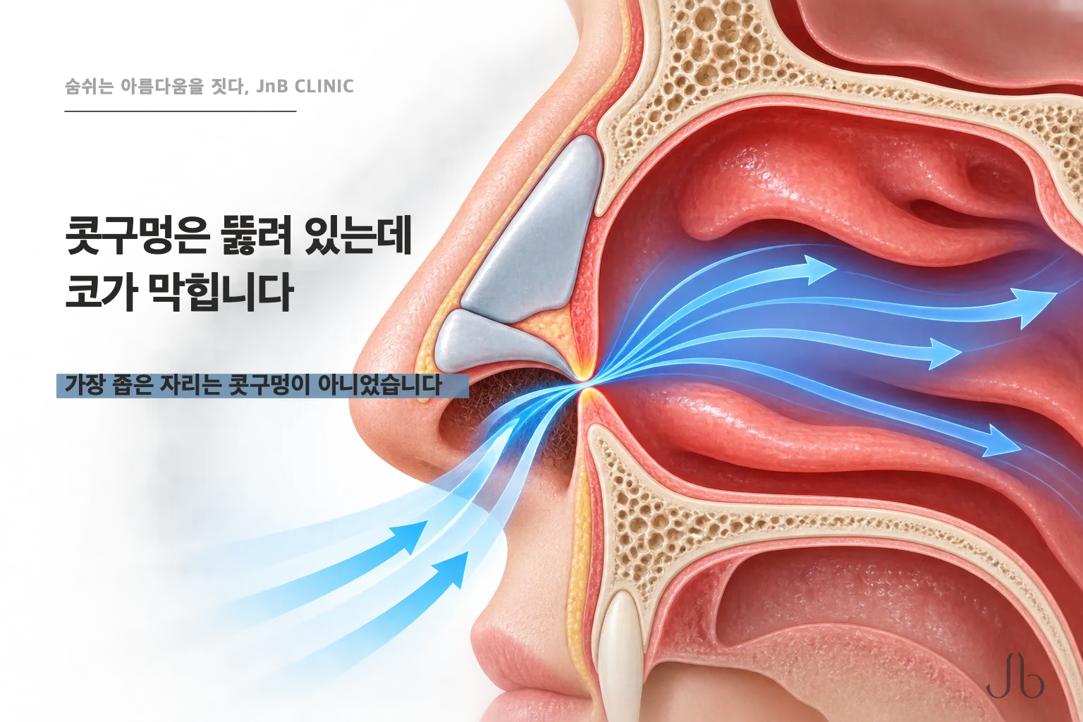 콧구멍은 뚫려 있는데 코가 막힙니다 — 자료가 가장 좁다고 적은 자리는 콧구멍이 아니었습니다