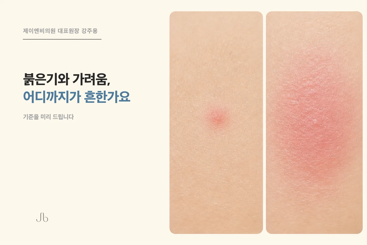 셀투오 시술 후 붉은기와 가려움, 어디까지가 흔한 반응인가요 (신사역 제이엔비의원 닥터 J)