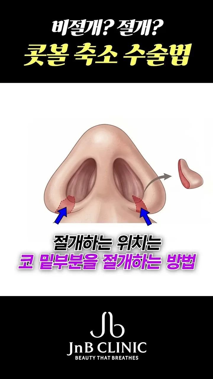 절개 위치를 표시한 코 일러스트 — 코 밑부분 절개를 화살표로 짚은 장면, 같은 영상 47초