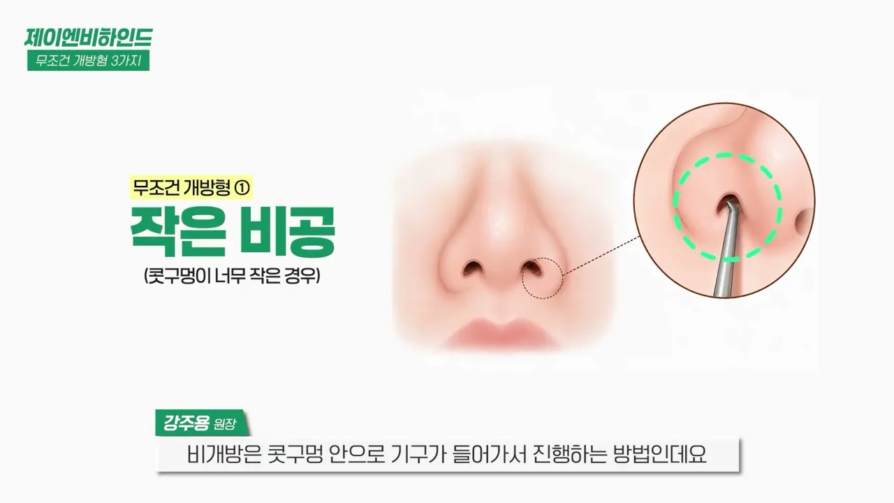 비개방 코성형이 어려운 콧구멍 — 이 정도 콧구멍에는 기구가 들어갈 자리가 나오지 않습니다, 같은 영상 3분 22초