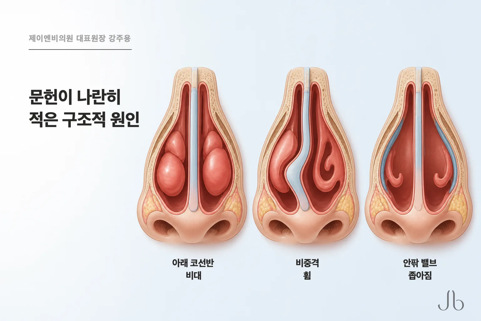 비중격 휨과 아래 코선반 비대, 안팎 밸브 좁아짐이 구조적 원인으로 한 줄에 나란히 적혀 있습니다