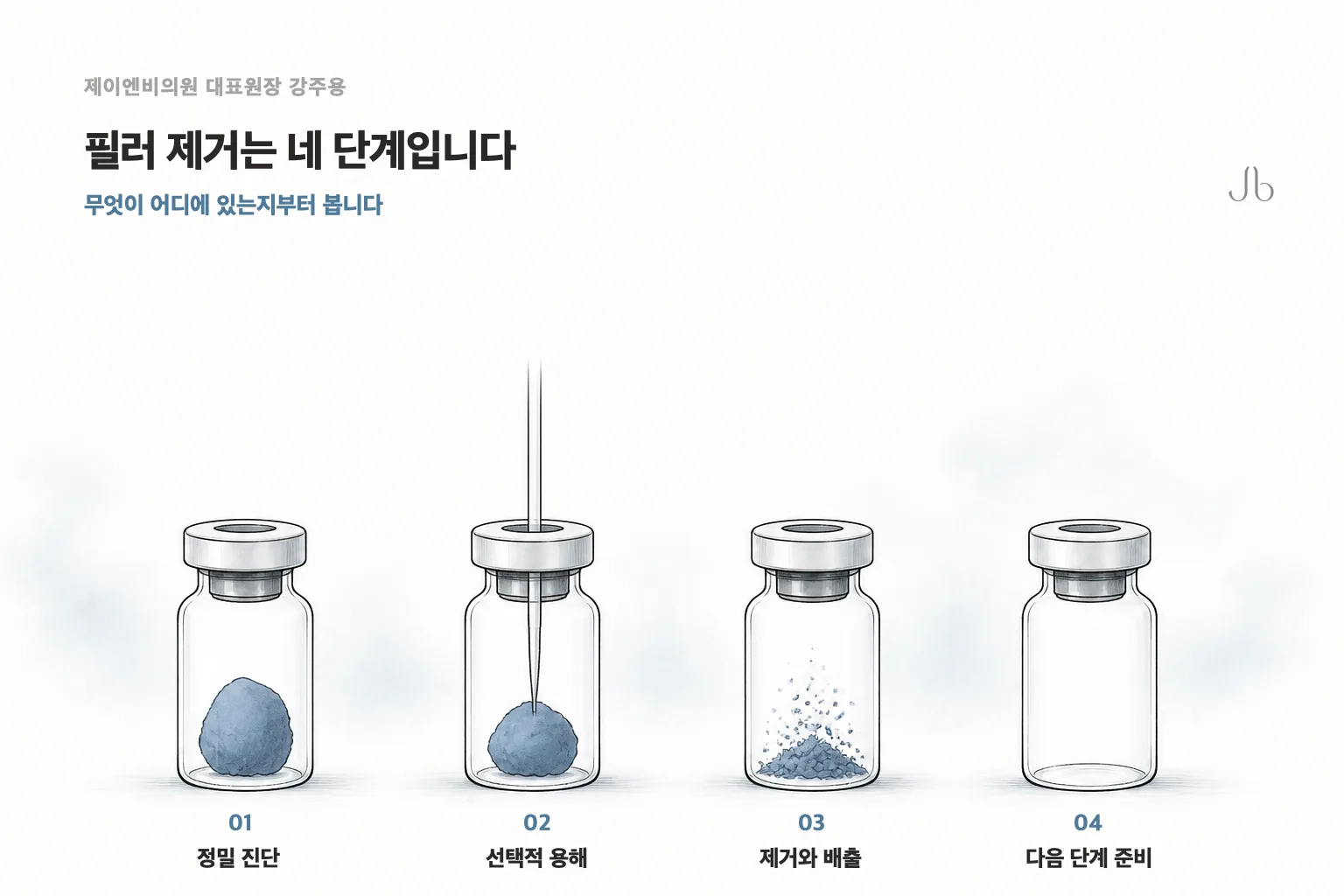 상담과 정밀 진단, 선택적 용해, 비침습적 제거와 배출, 다음 단계 준비로 이어지는 필러 제거 4단계 순서도