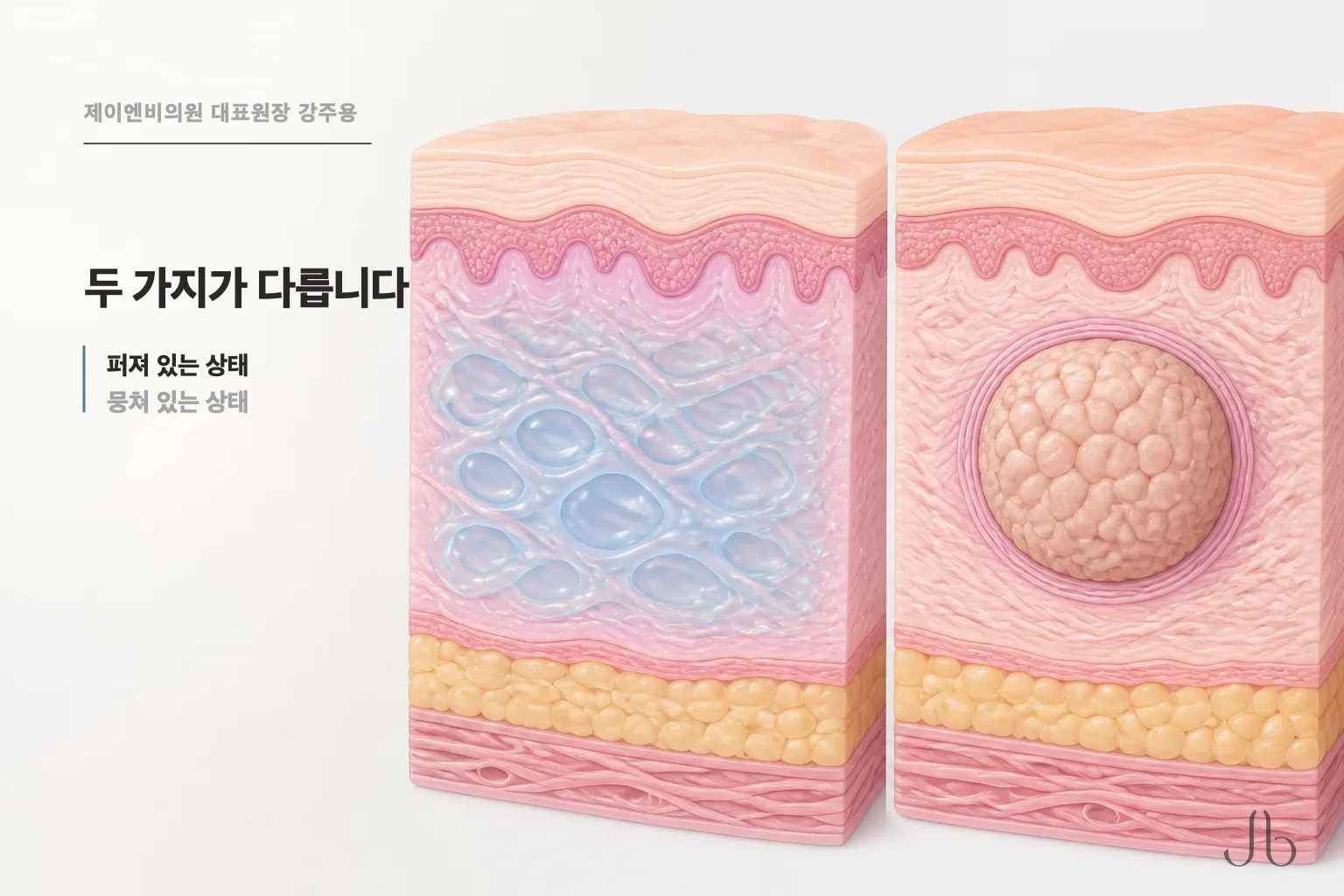 시간이 지나며 잦아드는 융기와 그렇지 않은 경우를 구분한 도식