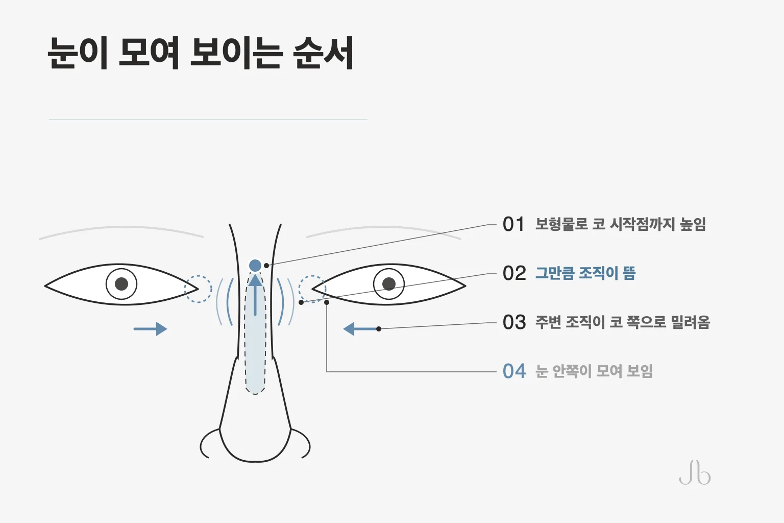 코 시작점을 높이면 조직이 뜨고 주변 조직이 밀려 눈 안쪽이 모여 보이기까지의 네 단계