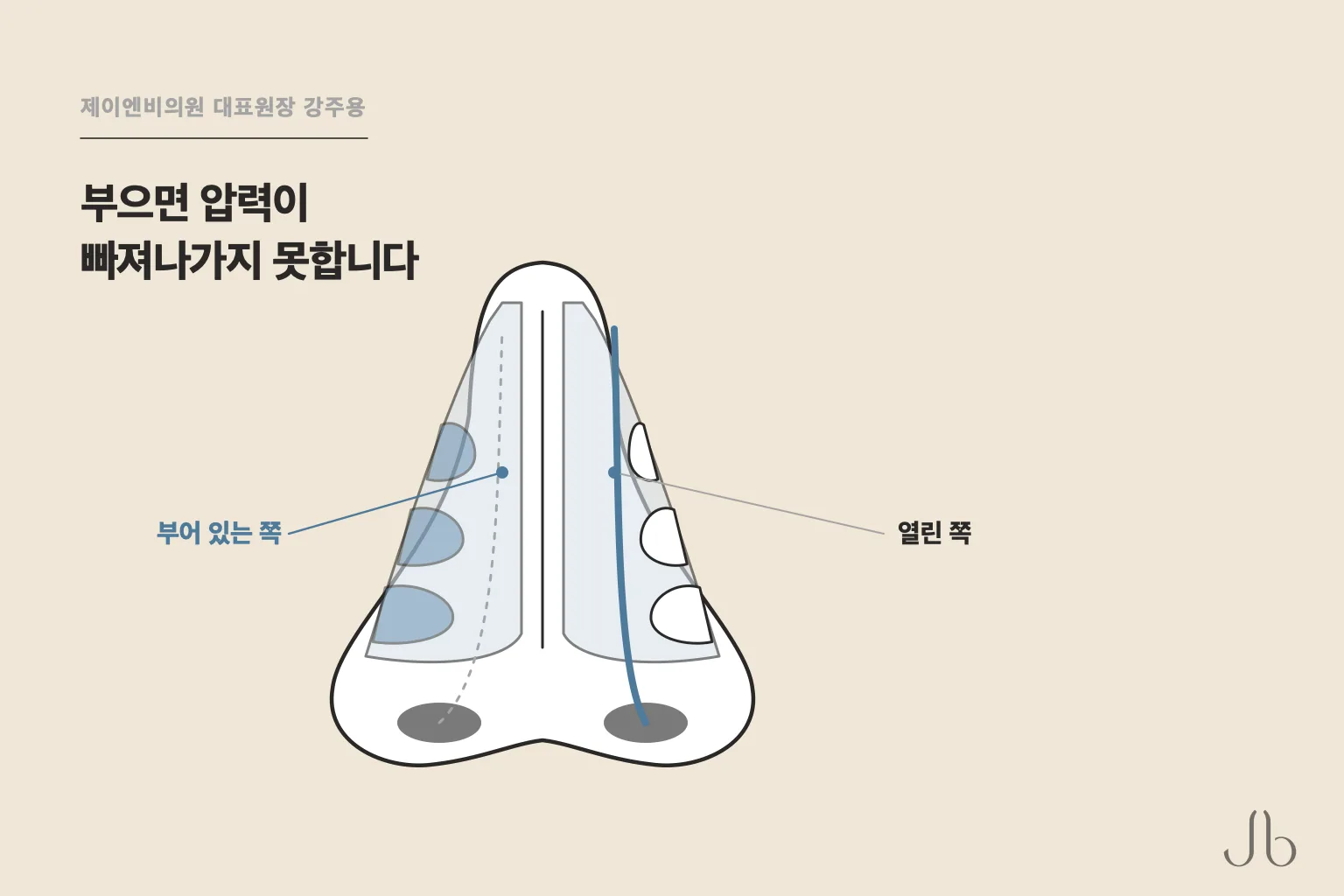 코막힘 상태에서는 코 통로가 부어 압력이 빠져나가지 못합니다 — 좁아진 쪽과 열린 쪽 비교