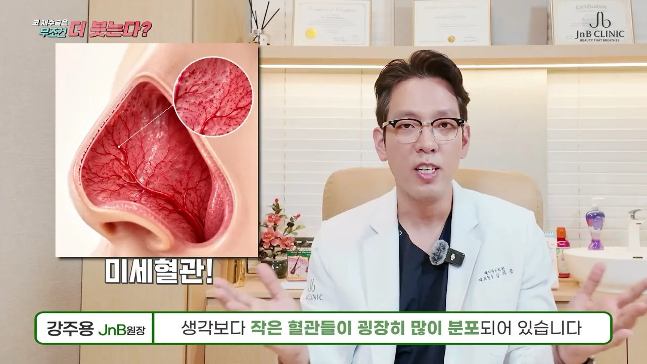 코수술 붓기와 코 안쪽 혈관 — 혈관이 얼마나 촘촘한지 확대해 놓은 그림, 유튜브 JNB Behind 「코수술 붓기가 남보다 빨리 빠지는 이유」 45초