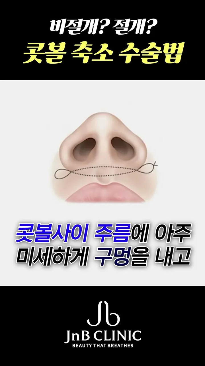 비절개 방식을 표현한 코 일러스트 — 콧볼 사이 주름의 미세한 구멍으로 실이 지나가는 모습, 「콧볼축소, 절개? 비절개?」 편 17초