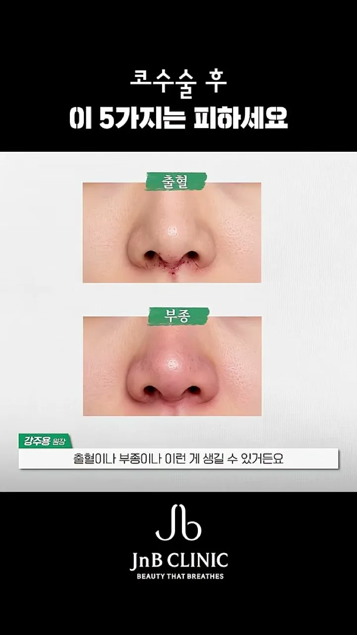 코 안 압력이 상승하면 출혈이나 부종이 생길 수 있다고 짚는 일러스트 화면 — 유튜브 JNB Behind 「코수술 후 무심코 하는 이 행동」 편 10초