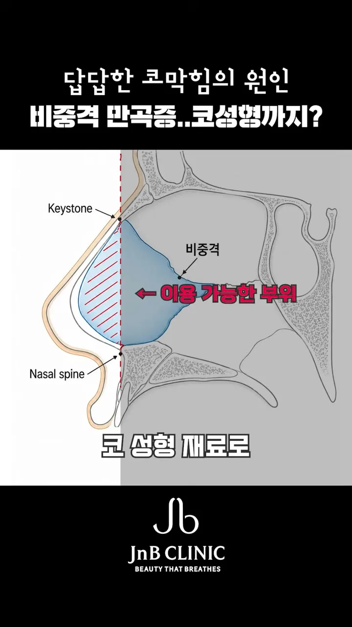 비중격연골 중 코성형 재료로 이용 가능한 부위를 표시한 코 단면 도해 — 같은 영상 42초 화면