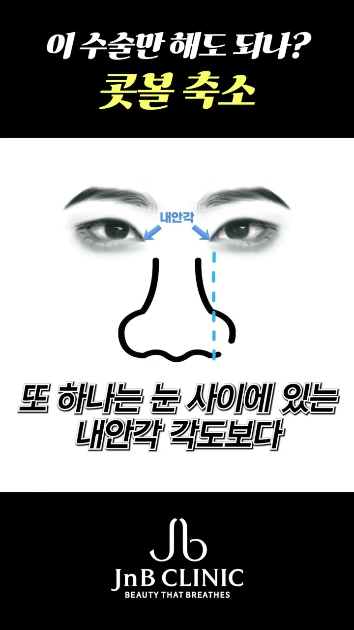 내안각 기준선과 콧볼 폭을 비교해 보여주는 선화 도식 — 유튜브 JNB Behind 「콧볼축소'만' 해도 되나?」 편 43초