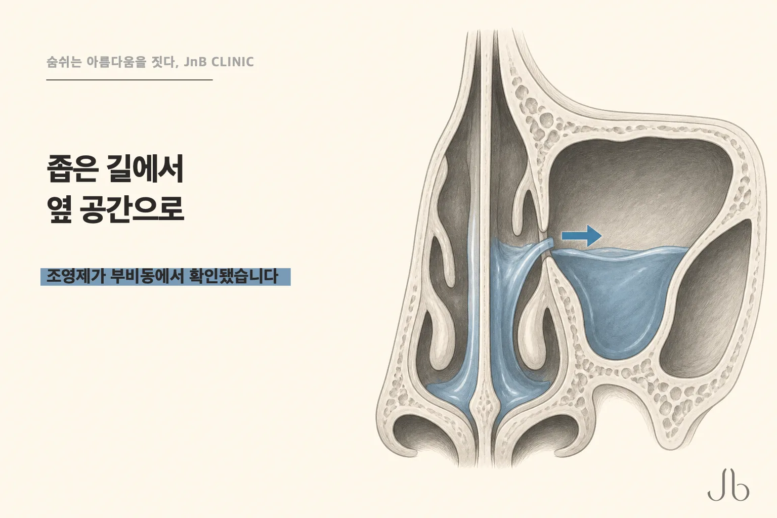코를 풀 때 액체가 좁은 통로에서 옆 공간으로 밀려 들어가는 방향을 표시한 부비동 도식