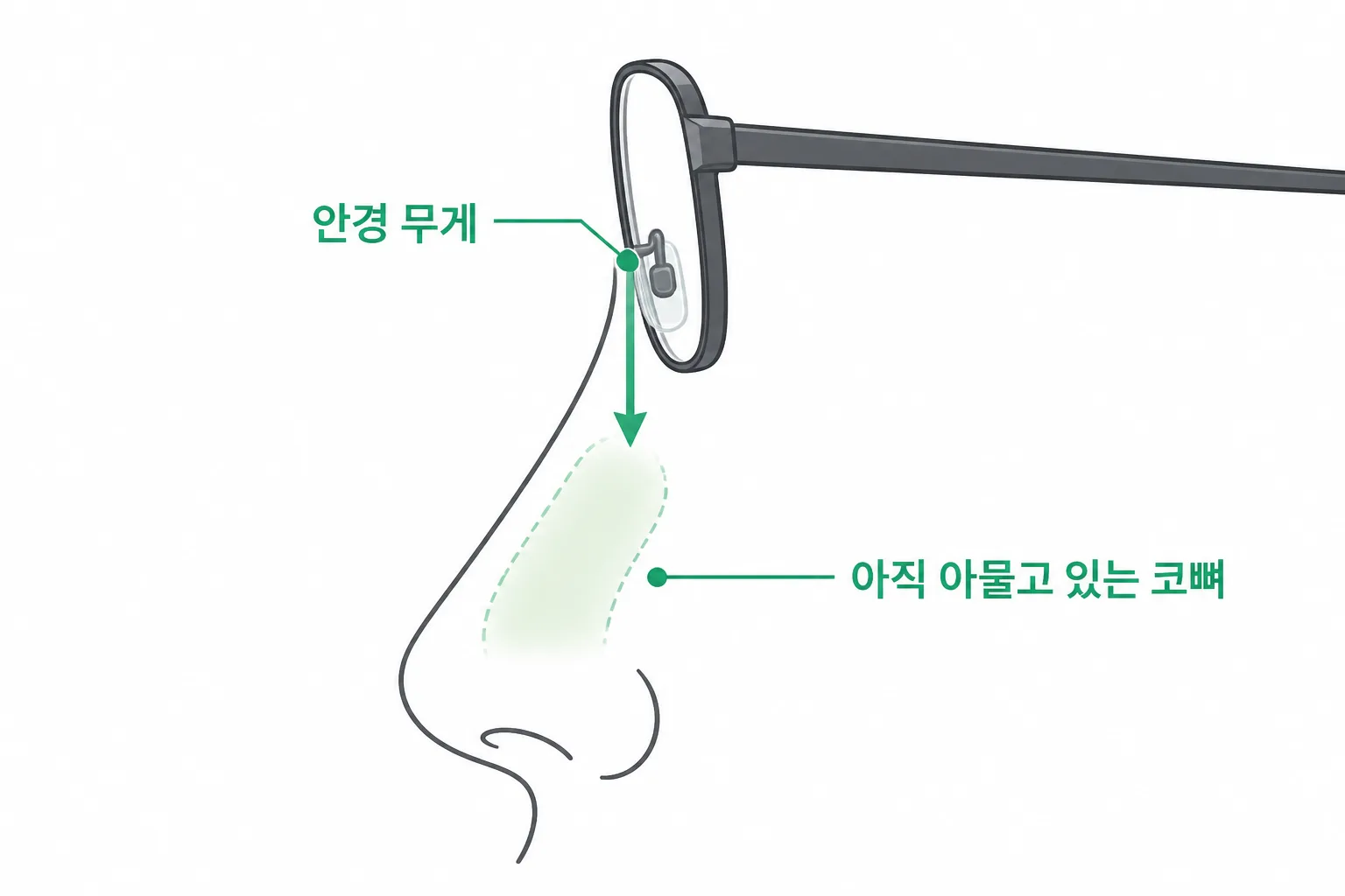 안경 무게가 콧등의 아물고 있는 코뼈 위에 얹히는 위치를 표시한 도식