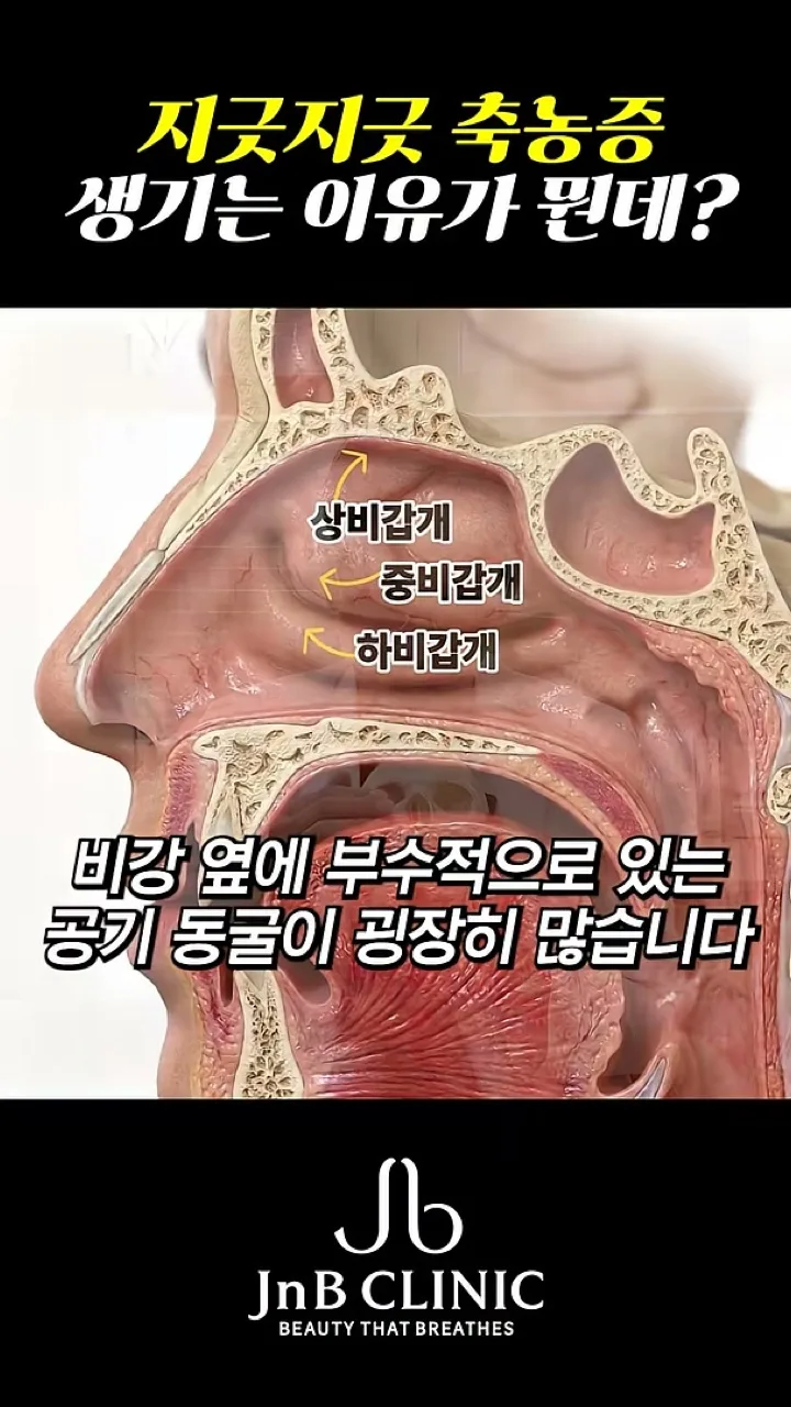 축농증이 생기는 코 안 구조, 비강 단면 일러스트 — 비강 옆에 공기 동굴(부비동)이 많다는 설명, 유튜브 JNB Behind 「지긋지긋한 축농증! 왜 생김?」 편 5초