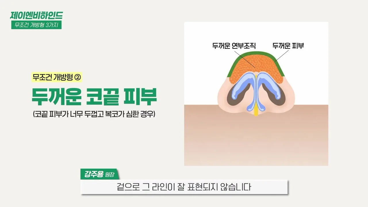 두꺼운 코끝 피부와 그 아래 연부조직의 단면 — 같은 영상 3분 48초