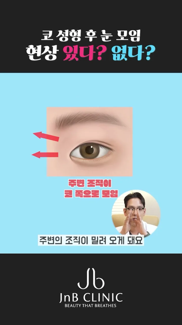 콧대가 높아지면 주변 조직이 코 쪽으로 밀려와 눈 안쪽이 모여 보인다는 설명 도해 — 유튜브 JNB Behind 0분 15초 화면