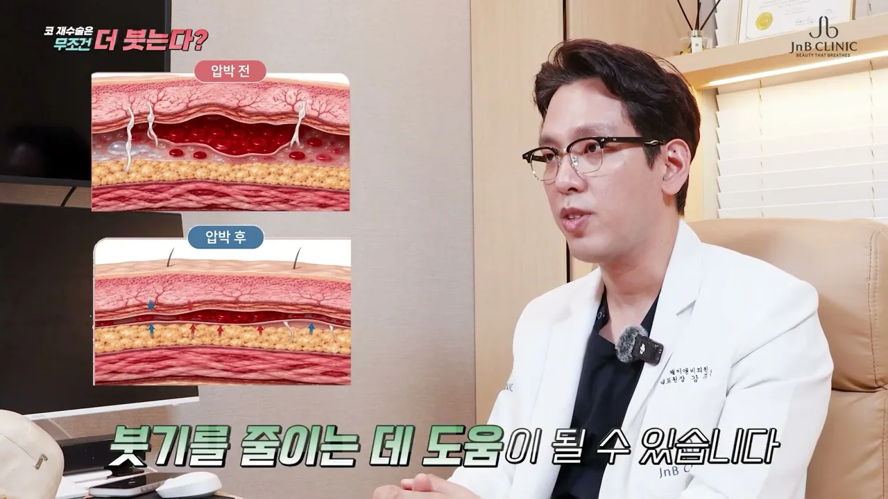 붓기를 줄이는 압박 — 압박이 들어가면 체액이 고일 공간이 줄어듭니다, 압박 전후 조직 단면 비교, 같은 영상 1분 40초